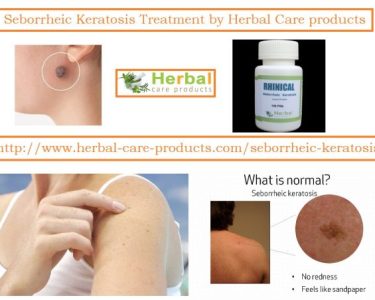 10 Natural Remedies for Seborrheic Keratosis