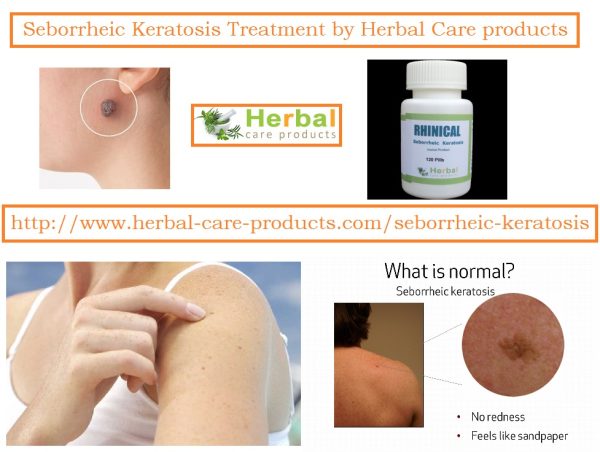 10 Natural Remedies for Seborrheic Keratosis