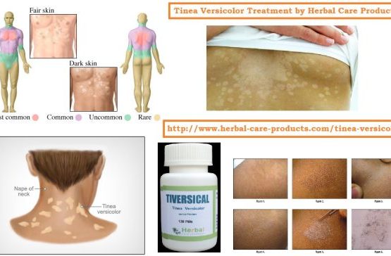 10 Natural Remedies for Tinea Versicolor