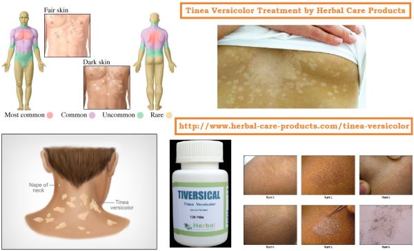 10 Natural Remedies for Tinea Versicolor