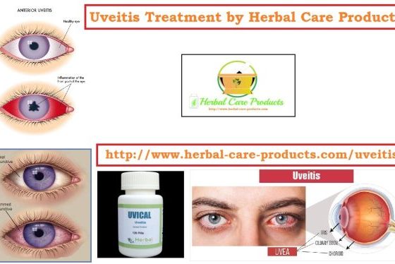 10 Natural Remedies for Uveitis
