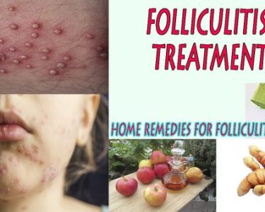 12 Natural Home Remedies for Folliculitis Treatment
