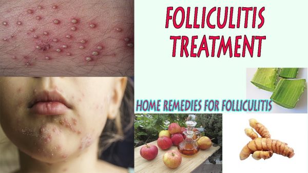 12 Natural Home Remedies for Folliculitis Treatment