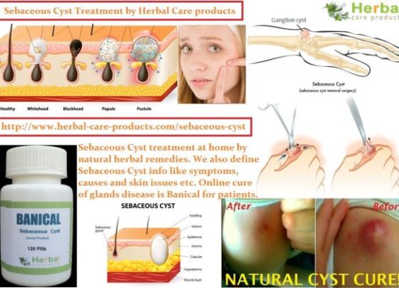 14 Herbal Cures for Sebaceous Cyst