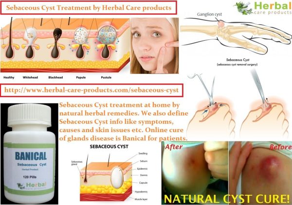 14 Herbal Cures for Sebaceous Cyst