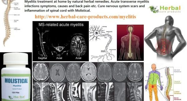 9 Natural Treatment for Myelitis