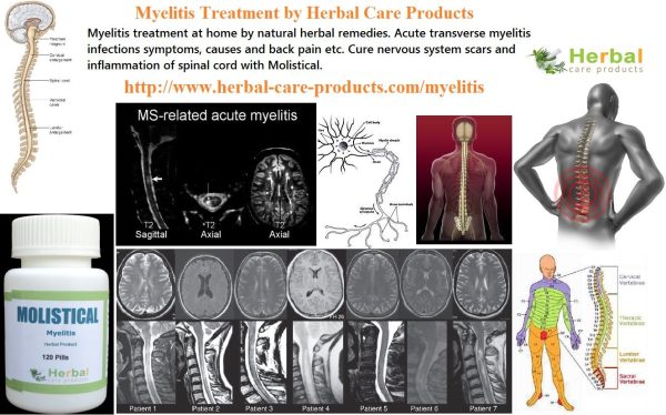 9 Natural Treatment for Myelitis