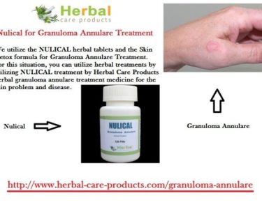9 Natural Treatments of Granuloma Annulare