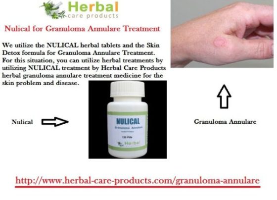 9 Natural Treatments of Granuloma Annulare