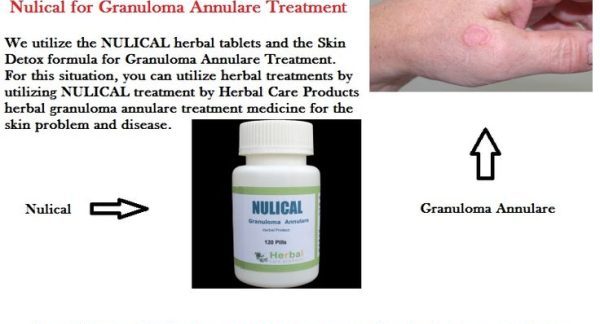 9 Natural Treatments of Granuloma Annulare