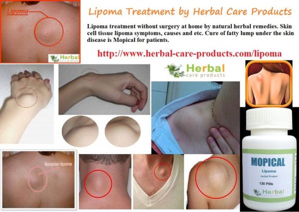 Best Lipoma Removal Supplement and Remedies