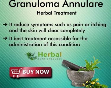 Best Way to Treat Granuloma Annulare Naturally at Home