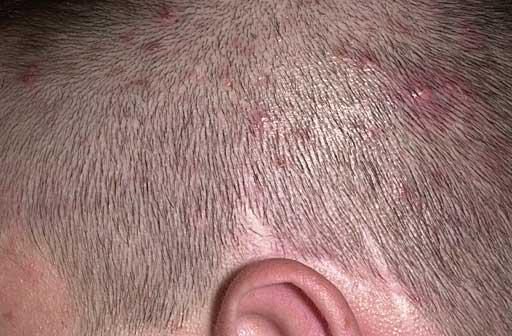 Breakthroughs in folliculitis!