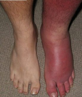 Cellulitis Treatment, Symptoms And Causes Of Infection