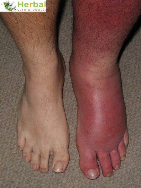 Treatment of Cellulitis by Natural Herbal Remedies