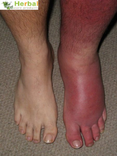 Cellulitis Treatment, Symptoms And Causes Of Infection