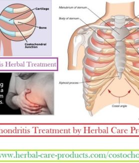 Costochondritis Herbal Treatment
