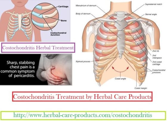 Costochondritis Herbal Treatment