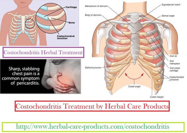 Costochondritis Herbal Treatment