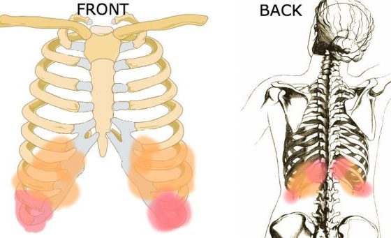Costochondritis Symptoms Treatment And Chest Pain Cause