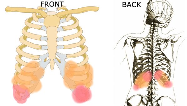 Costochondritis Symptoms Treatment And Chest Pain Cause