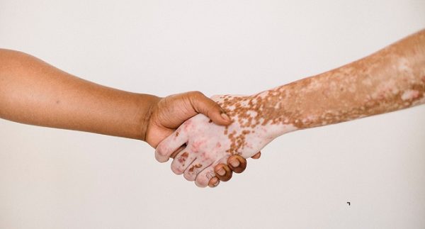 Early Scleroderma Warning Signs: 5 Symptoms You Shouldn’t Ignore
