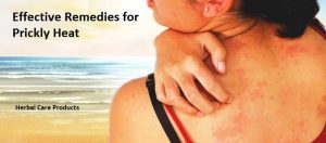 Effective Remedies for Prickly Heat That Work