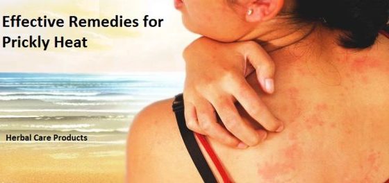 Effective Remedies for Prickly Heat That Work