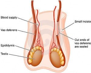 Epididymitis – Azoospermia