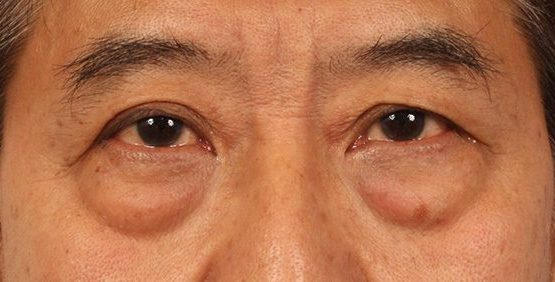 Eye Bags - Red Puffiness of Eyes