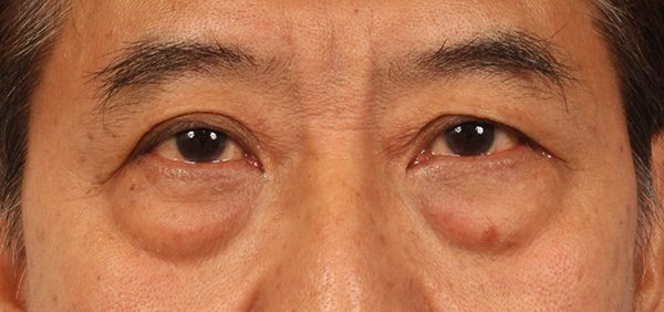 Eye Bags – Red Puffiness of Eyes
