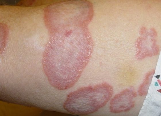 Granuloma Annulare - Auto Immune Skin Disorder
