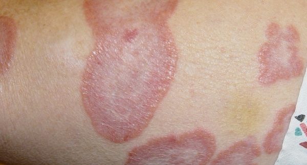 Granuloma Annulare - Auto Immune Skin Disorder