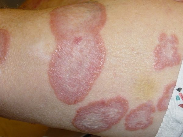 Granuloma Annulare – Auto Immune Skin Disorder