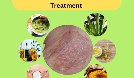 Granuloma Annulare Natural Treatment (2)