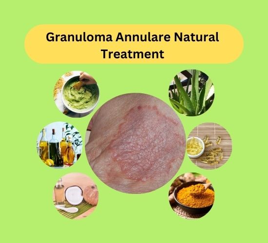 Granuloma Annulare Natural Treatment