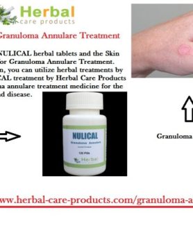 Granuloma Annulare Natural Treatment