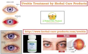 Home-Remedies-for-Uveitis-768x478