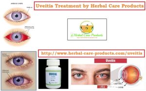 Home-Remedies-for-Uveitis-768x478