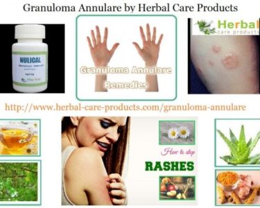 How Natural Herbal Ingredients Treat Granuloma Annulare