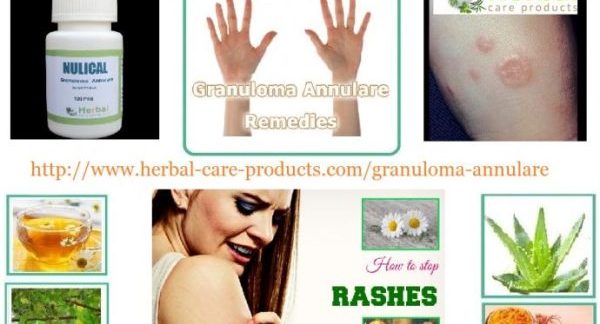 How Natural Herbal Ingredients Treat Granuloma Annulare