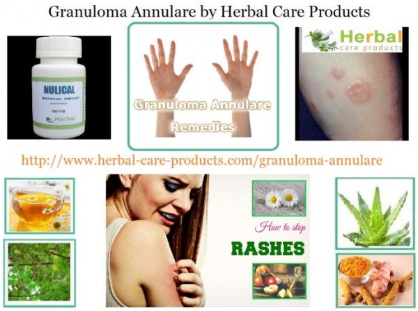 How Natural Herbal Ingredients Treat Granuloma Annulare