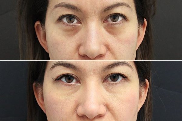 How To Eliminate Eye Bags: Easy Home Remedies And Beauty Hacks