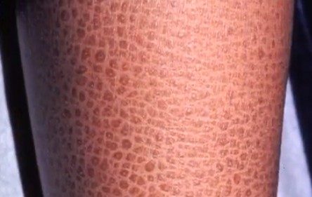 Ichthyosis – Skin Congenital Condition