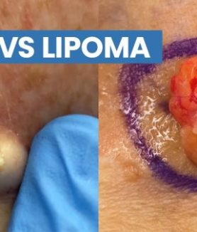 Lipoma vs Sebaceous Cyst Definition, Causes, and Symptoms