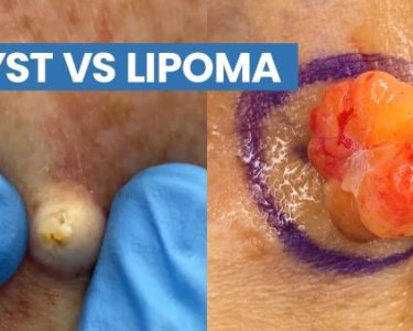 Lipoma vs Sebaceous Cyst Definition, Causes, and Symptoms