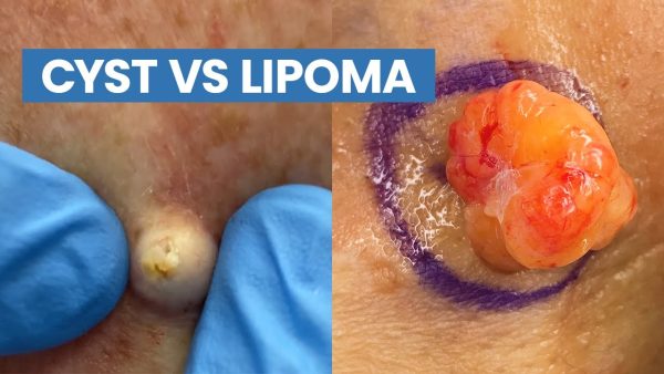 Lipoma vs Sebaceous Cyst: Definition, Causes, and Symptoms