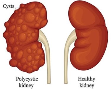 Most 12 Deadly Symptoms Of Kidney Diseases You Shouldnt Ignore