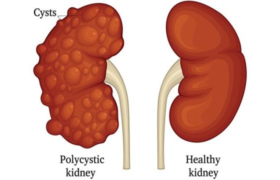 Most 12 Deadly Symptoms Of Kidney Diseases You Shouldnt Ignore