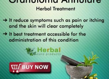 Natural Herbal Remedies for Granuloma Annulare